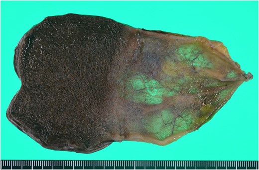Resected specimen. A borderline between ischaemic change and non-ischaemic change in the specimen was apparent.