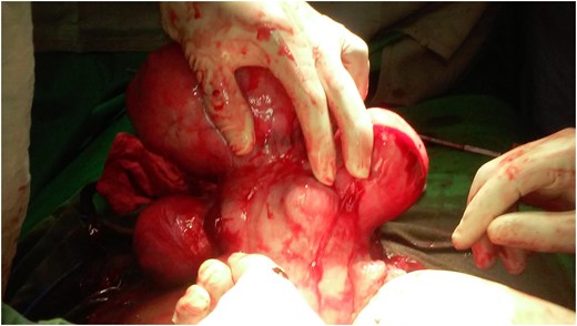 Posterior wall of uterine myomas showing multiples subserous myomas.