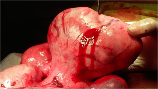 Active bleeding of superficial ruptured varice overlying a subserous myoma.