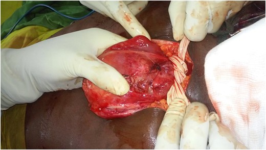 Glove applied at the base of the uterus.