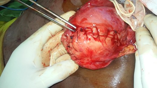 Uterus after glove removal.