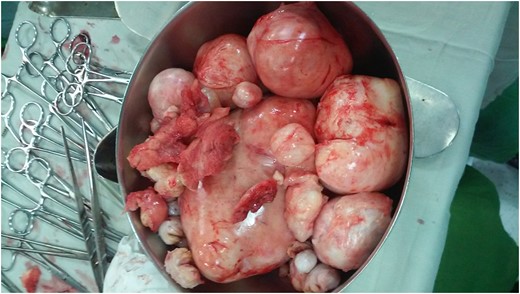 Specimen of excised uterine myomas.