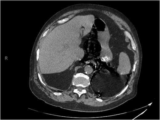 Representative slice from abdominal computed tomography imaging on admission.