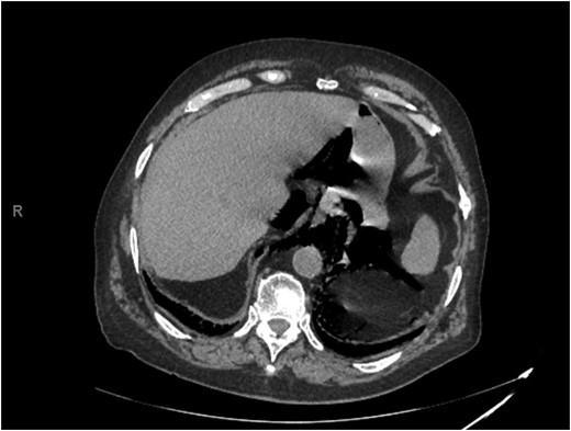 Representative slice from abdominal computed tomography imaging on admission.