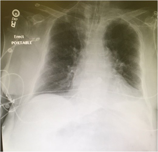 Portable semi-upright chest x-ray demonstrating an endotracheal tube in proper position, no pneumothorax, and possible left pleural effusion. No evidence of widened mediastinum or free air under the diaphragm. The nasogastric tube is visible coursing through the right internal jugular vein to the superior vena cava. The tip of the nasogastric tube is not visible.
