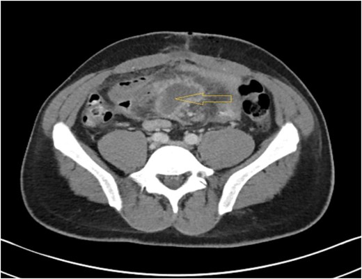 CT abdomen showing mesenteric abscess.