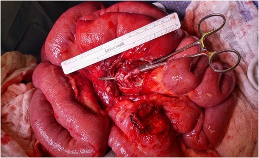 Intra-operative demonstration of mesenteric abscess.