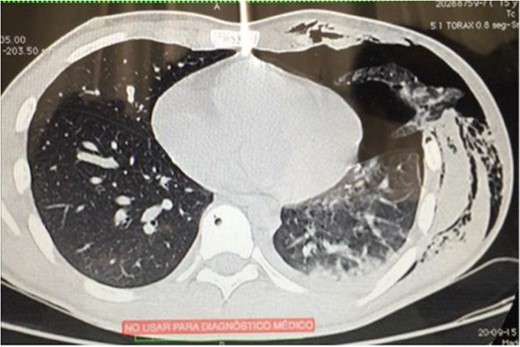 Chest CT scan showing pneumothorax and lung herniation.