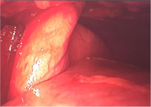 Lung herniation seen through VATS pleuroscopy.