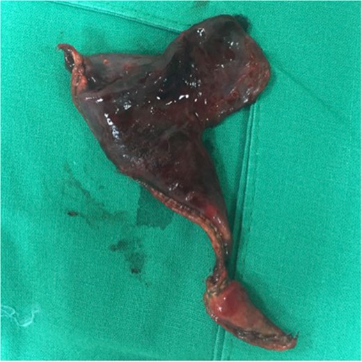Wedge resection of ischemic lung through chest wall herniation.