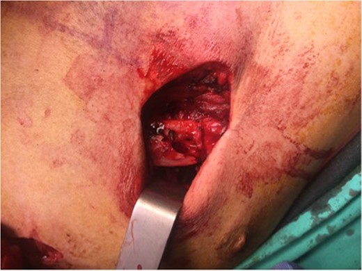 Reduced rib fracture previous to rib fixation.