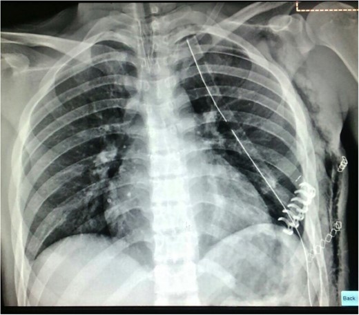 Post-operative chest X ray in recovery room.
