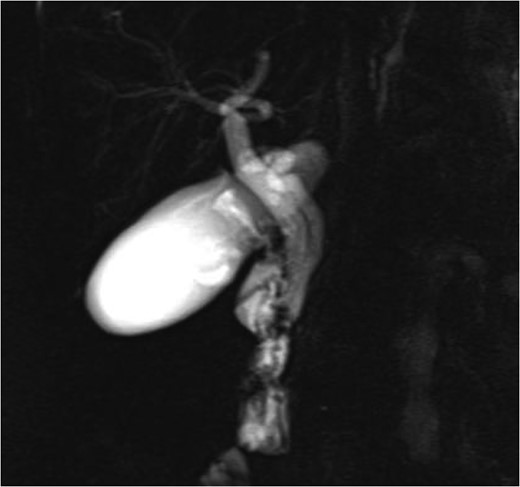 MRCP image showing long parallel course of the cystic duct inserting medially just proximal to the ampulla of Vater.