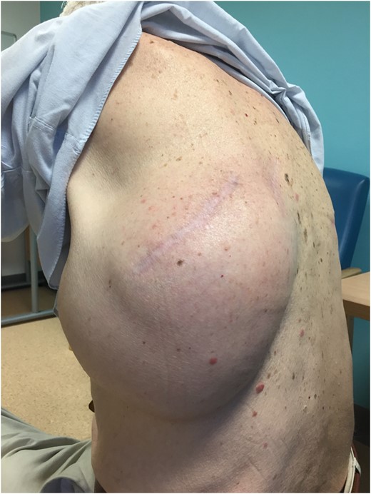 Clinical presentation of the giant post-pneumonectomy cavity herniation.