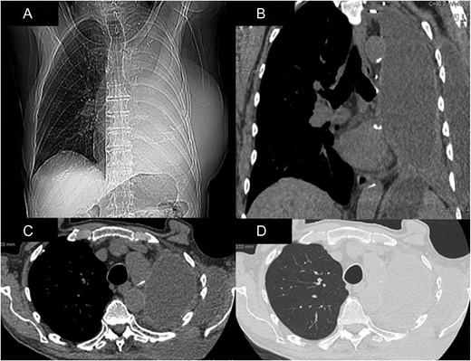 CT-scan demonstrating the impressive hernia in coronal views (A and B) and axial views (C and D).