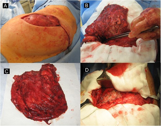 Pleural hernia sac appearance after the thoracotomy incision (A), intercostal herniation site pointed by surgeon’s forceps (B), excised hernia sac (C) and appearance of the defect after repair with polypropylene mesh (D).
