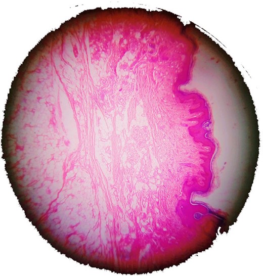 The superficial layer of the lesion showing angiokeratoma (haematoxylin and eosin).