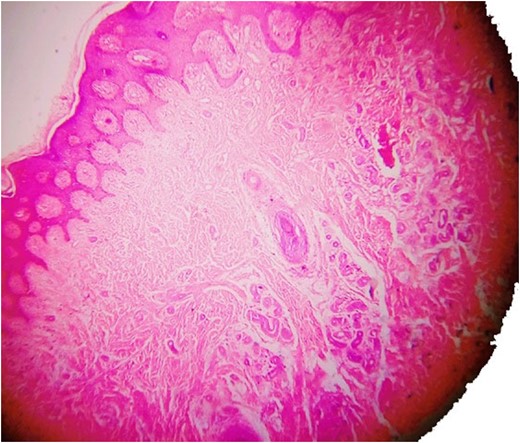 Haematoxylin and eosin staining showing eccrine angiomatous hamartoma.