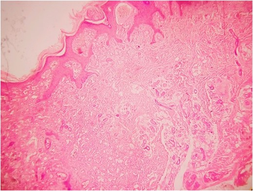 Another magnified section from showing thick walled capillaries.