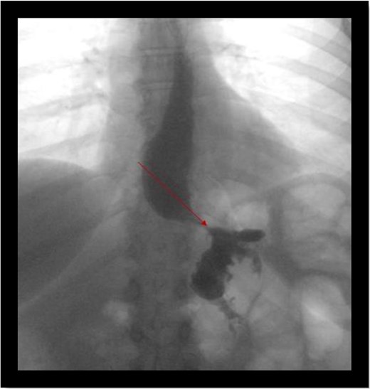 Upper GI study showing no evidence of leak.