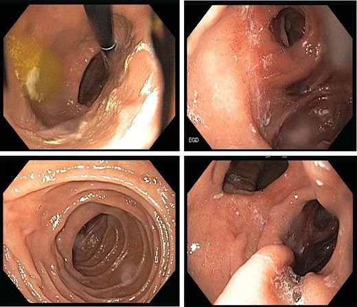 EGD showing the gastro-gastric fistula.