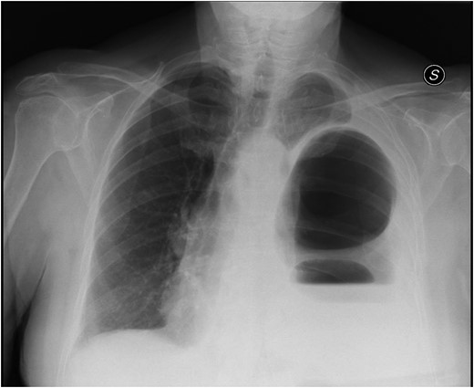 Chest X-ray showing left colon herniation.
