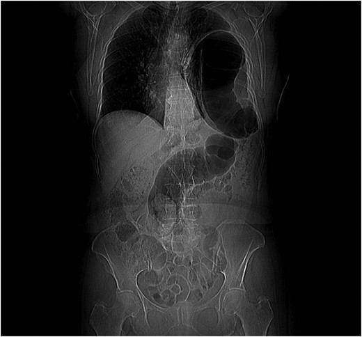 CT scan image showing left colon herniation.