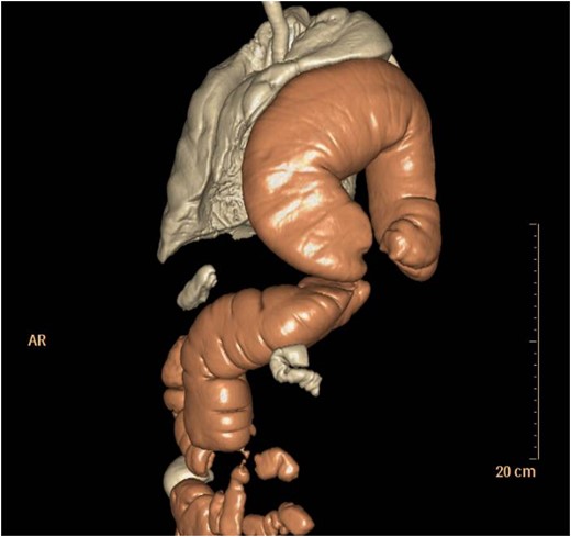 3D CT reconstruction.