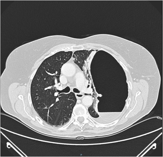 CT of chest showing defect on left side of the diaphragm and colon herniation in the thoracic cavity.