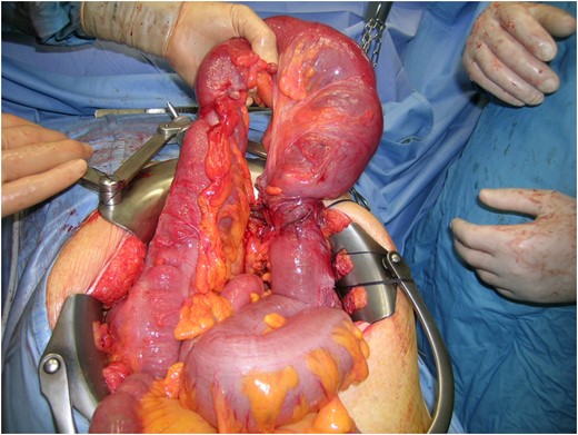 Intra-operative image of trasverse colon herniation.