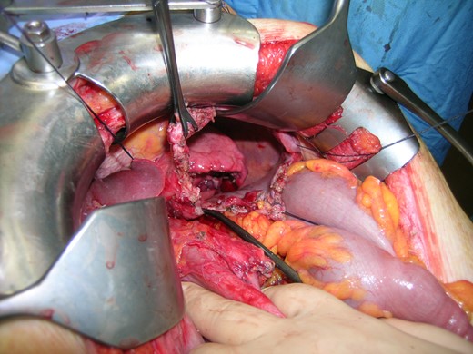 Intra-operative diaphragmatic defect.