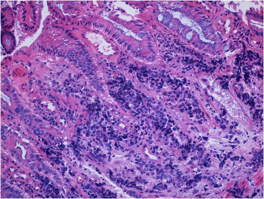 Pathologic specimen consistent with small cell neuroendocrine malignancy of the rectum. This specimen stained positively for synaptophysin, chromogranin and TTF-1 (not shown). Not seen in this image is a significant necrotic contribution consistent with high-grade pathology.