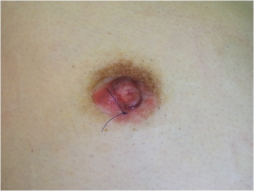Right breast after skin biopsy. Erosion and redness of the nipple–areola complex were noted. A lump, 11 mm, was palpated in the breast. A skin biopsy suture can be seen.