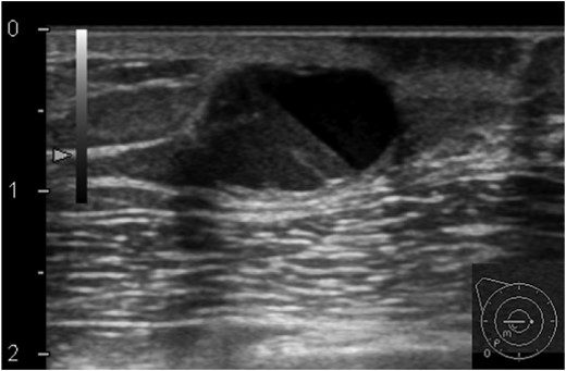 Ultrasonography of the right breast at first presentation. A cystic mass, 13 mm, with the appearance of rippling water can be seen below the right areola.