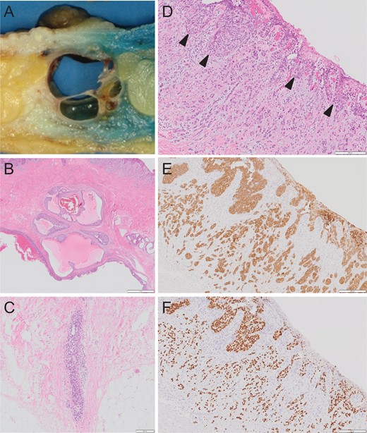 Macroscopic appearance of the specimen (A). Multiple cystic lesions can be seen below the nipple. Histopathological findings of non-invasive breast cancer in the cystic lesion of the breast parenchyma (B). Ductal carcinoma cells can be seen. Intraductal spread in the major lactiferous duct (C). Histopathological findings of Paget’s cells (arrowhead) and invasive foci in the dermis (D). Immunohistochemical study of the Paget’s cells and invasive foci revealed diffusely positive staining for CAM5.2 (E) and ER (F).