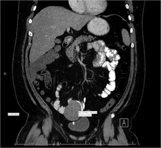 Coronal slice of the CT of the abdomen/pelvis demonstrating a lesion arising from the mid-to-distal small bowel.