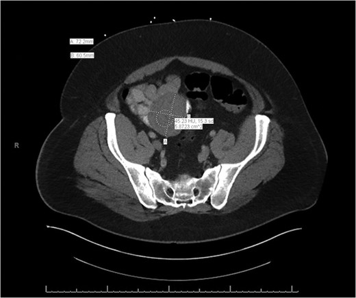 Axial slice of the CT of the abdomen/pelvis demonstrating a lesion arising from the mid-to-distal small bowel.