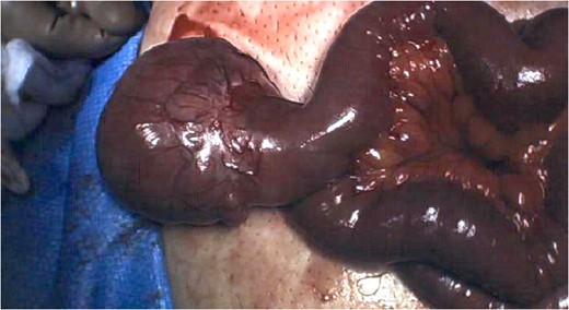 Intraoperative photograph of large, pedunculated mass arising from the wall of the jejunum.