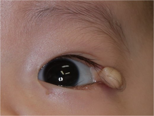 A polypoidal appendage was seen on the left lateral corner of upper eyelid. On the surface, hair was observed. Sub-conjunctival extent could be seen.