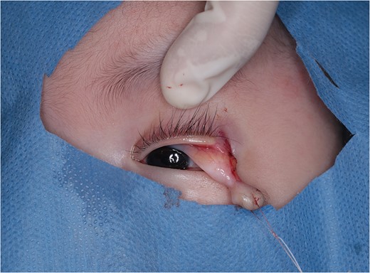 Upper and lateral margin of the tumour was incised. Continuity to palpebral tarsal plate and the lateral canthal ligament was cut.