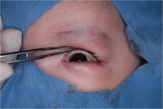 Immediately after the operation. Detached tarsal plate was fixed to the lateral canthal ligament.
