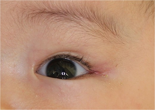Two months after the operation. No aesthetic and functional deficit was observed.