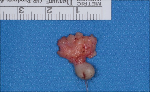 Gross observation of the excised tumour. Vasculature was observed on the surface of lobular sub-conjunctival part.