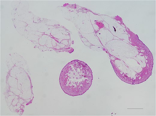 Low magnification observation, taken with ×2 objective lens and stitched. Hematoxylin and Eosin stained. Black bar represents 500 μm. Most part of the tumour was composed of adipose tissue, lobuled by fibrous septum.