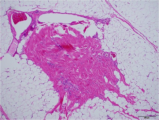 Dense fibrous part with vasculature, surrounded by adipose tissue, assumed to be the link of tarsal plate. ×10 objective lens. Black bar represents 200 μm.