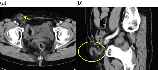Abdominal enhanced computed tomography imaging showing (a) the enhanced tubular structure in the femoral hernia and (b) the caecum.