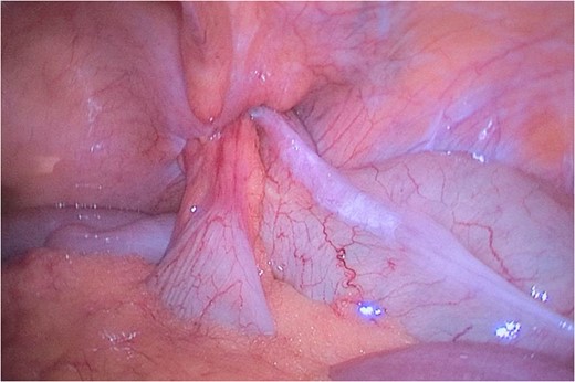 Laparoscopic findings showing migration of the appendix into the femoral hernia.