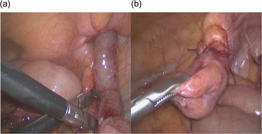 (a) Inflamed and partly necrotic appendix was reduced during laparoscopy. (b) Hernial sac was ligated and cut during laparoscopy.