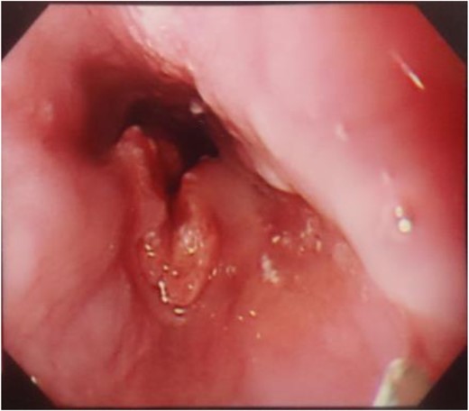 A type 2 tumor occupying one-third of the circumference of the esophagus on esophagogastroduodenoscopy.