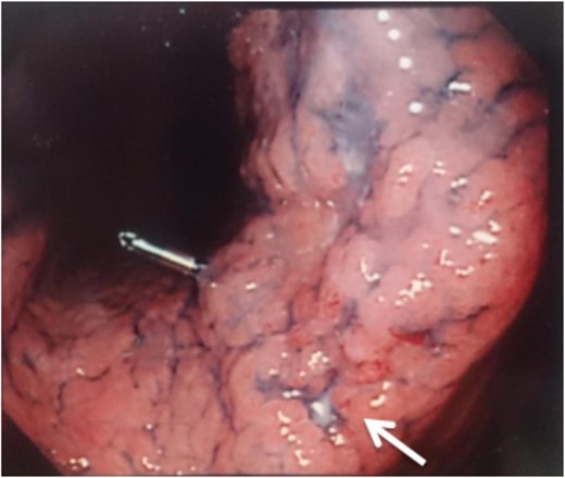 A type 0-IIb tumor located at the lesser curvature of the angle of the stomach on esophagogastroduodenoscopy.